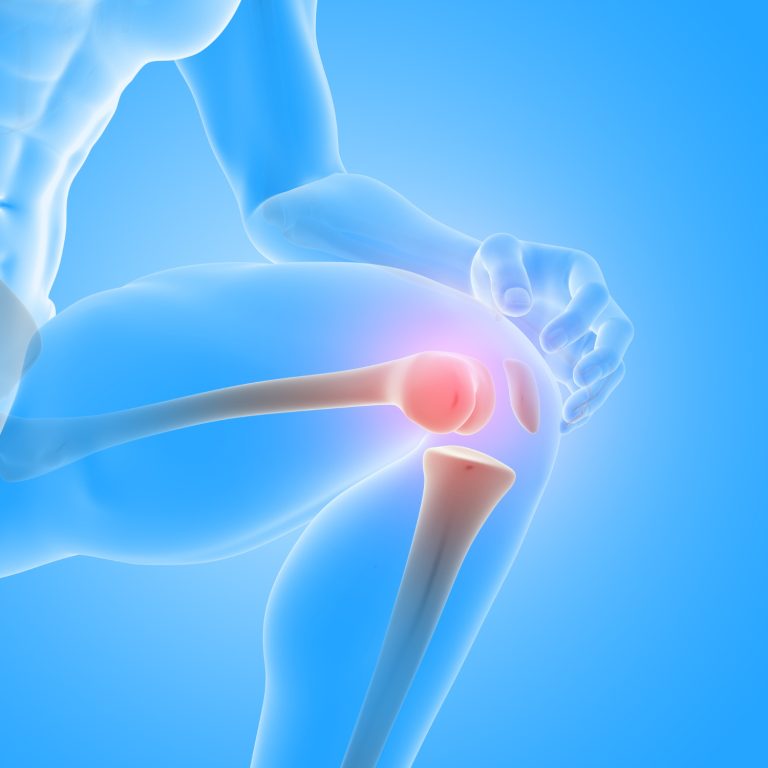 Knee Surgery in Sonheuwel: When Physiotherapy Isn’t Enough